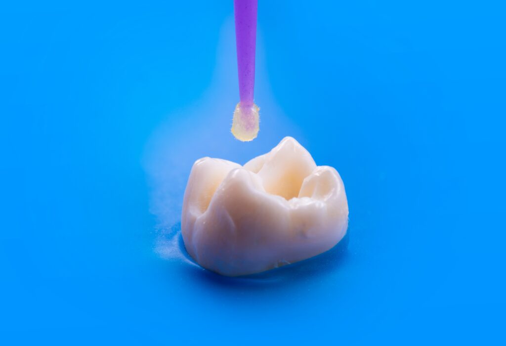 dental bonding el paso