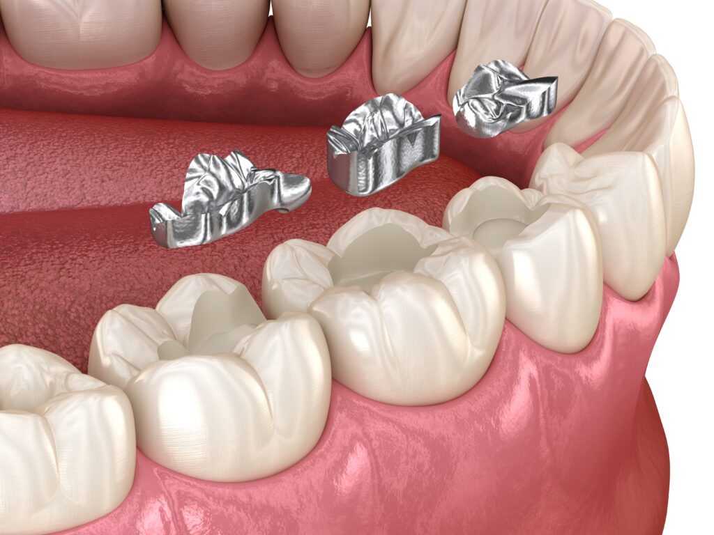 dental sealants el paso